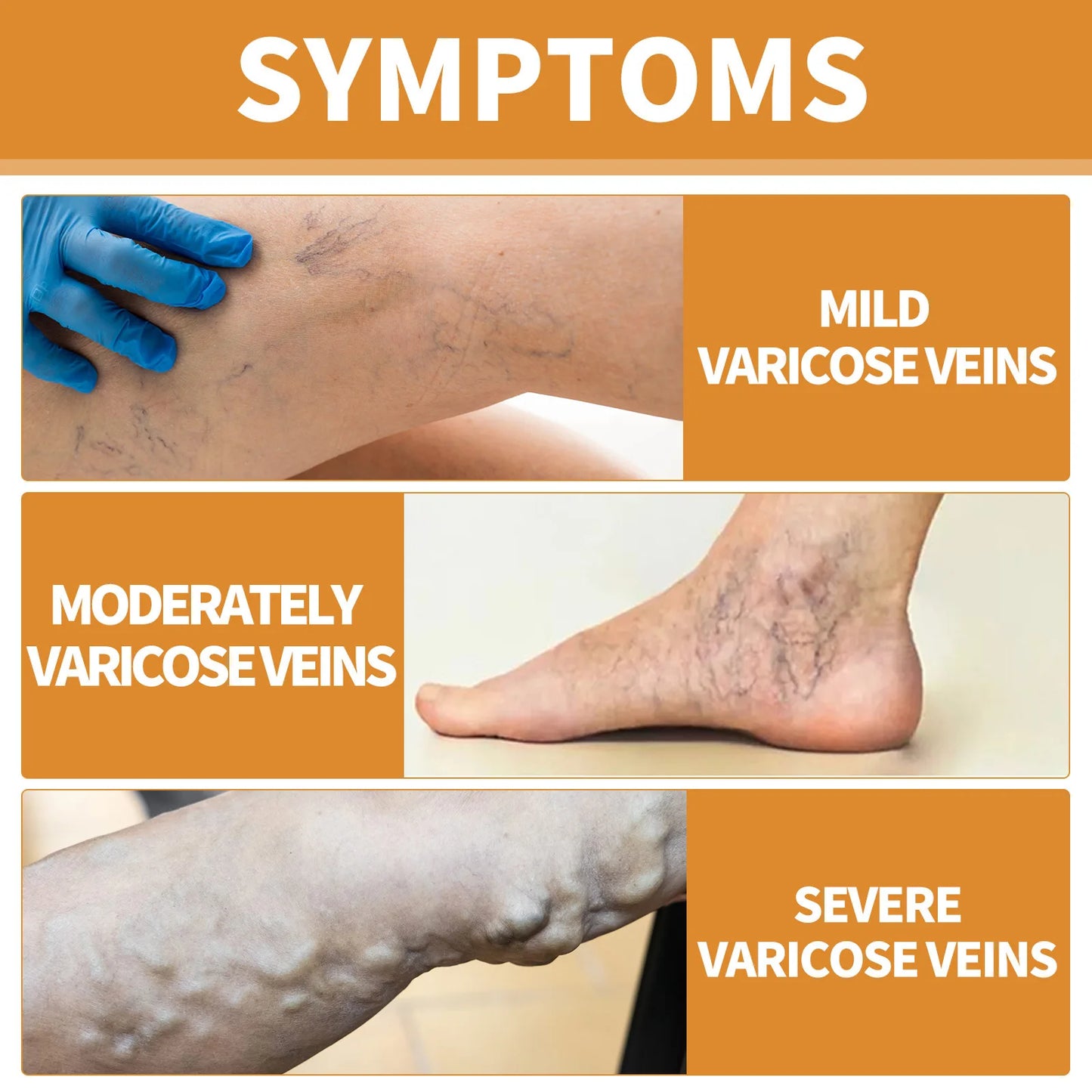 Varicose Veins Treatment Cream